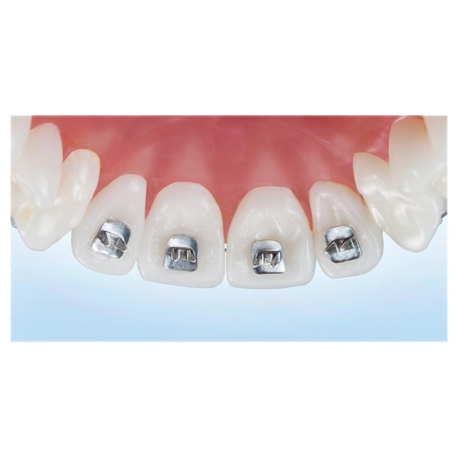 Tongue Tamers Spur / Spike Habit Appliance Rectangular Lingual 10/Pk product image